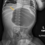 Incarcerated Gastric Volvulus and Splenic Herniation. Abdominal Radiograph. Annotated. JETem 2025