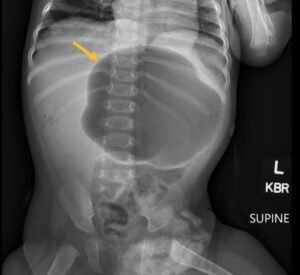 Incarcerated Gastric Volvulus and Splenic Herniation. Abdominal Radiograph. Annotated. JETem 2025