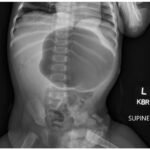 Incarcerated Gastric Volvulus and Splenic Herniation. Abdominal Radiograph. Unannotated. JETem 2025