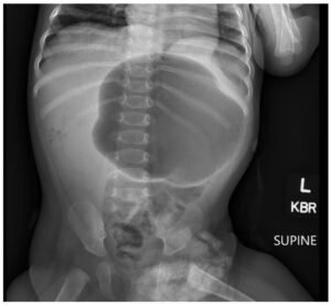 Incarcerated Gastric Volvulus and Splenic Herniation. Abdominal Radiograph. Unannotated. JETem 2025
