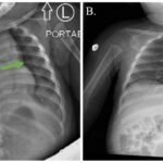 Incarcerated Gastric Volvulus and Splenic Herniation. Chest Radiographs on Postoperative Days 1 and 4. Annotated. JETem 2025