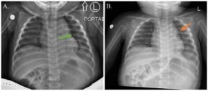 Incarcerated Gastric Volvulus and Splenic Herniation. Chest Radiographs on Postoperative Days 1 and 4. Annotated. JETem 2025