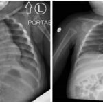 Incarcerated Gastric Volvulus and Splenic Herniation. Chest Radiographs on Postoperative Days 1 and 4. Unannotated. JETem 2025