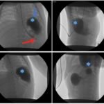 Incarcerated Gastric Volvulus and Splenic Herniation. Upper GI. Annotated. JETem 2025