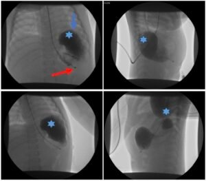 Incarcerated Gastric Volvulus and Splenic Herniation. Upper GI. Annotated. JETem 2025