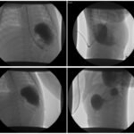 Incarcerated Gastric Volvulus and Splenic Herniation. Upper GI. Unannotated. JETem 2025