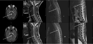 Mycoplasma Associated Acute Transverse Myelitis. MRI. Annotated. JETem 2025