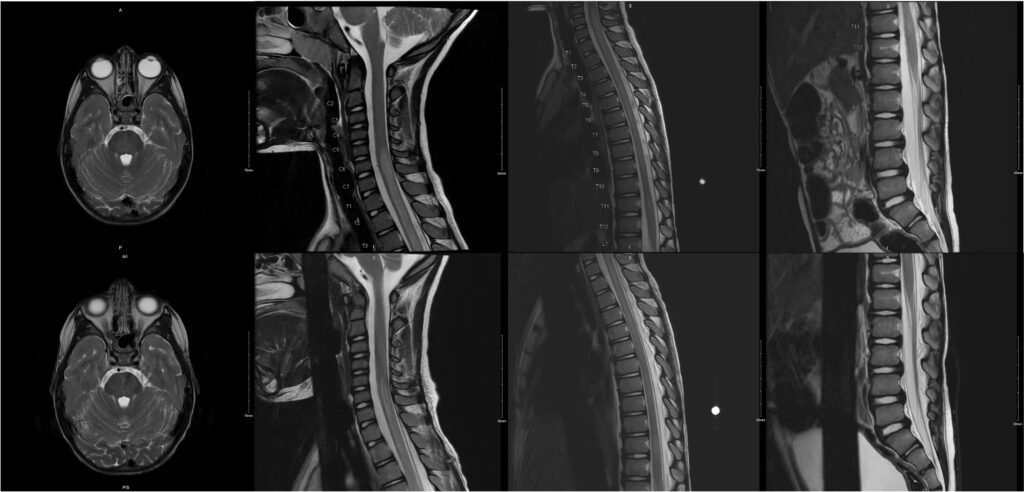 Mycoplasma Associated Acute Transverse Myelitis. MRI. Unannotated. JETem 2025