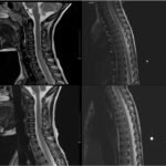 Mycoplasma Associated Acute Transverse Myelitis. MRI. Unannotated. JETem 2025