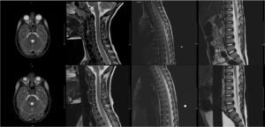 Mycoplasma Associated Acute Transverse Myelitis. MRI. Unannotated. JETem 2025