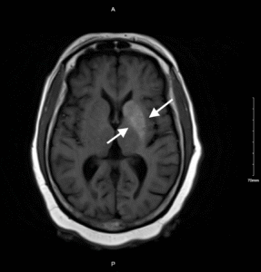 Nonketotic Hyperglycemia Hemichorea. MRI Annotated. JETem 2025