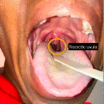 Uvular Necrosis Photo. Annotated. JETem 2025