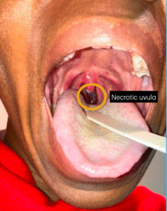Uvular Necrosis Photo. Annotated. JETem 2025