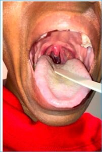 Uvular Necrosis Photo. Unannotated. JETem 2025