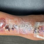 Dermatologic Reaction to Wound Closure Strips and Liquid Adhesive. Photo 2 Unannotated. JETem 2025