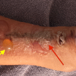 Dermatologic Reaction to Wound Closure Strips and Liquid Adhesive. Photo 3 Annotated. JETem 2025