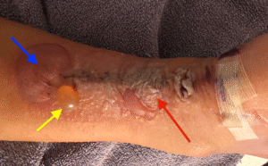 Dermatologic Reaction to Wound Closure Strips and Liquid Adhesive. Photo 3 Annotated. JETem 2025
