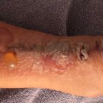 Dermatologic Reaction to Wound Closure Strips and Liquid Adhesive. Photo 3 Unannotated. JETem 2025