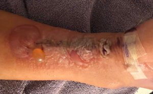Dermatologic Reaction to Wound Closure Strips and Liquid Adhesive. Photo 3 Unannotated. JETem 2025