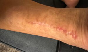 Dermatologic Reaction to Wound Closure Strips and Liquid Adhesive. Photo 5. JETem 2025