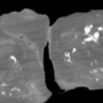 Atypical Presentation of Fourniers Gangrene. CT. JETem 2026