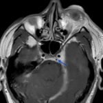 Carotid Cavernous Fistula MRI 1 annotated blue arrow. JETem 2026