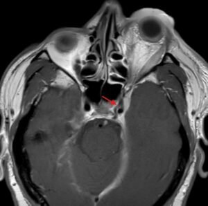 Carotid Cavernous Fistula MRI 1 annotated red arrow. JETem 2026