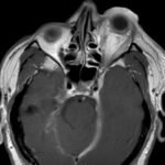 Carotid Cavernous Fistula MRI 1. JETem 2026