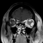 Carotid Cavernous Fistula MRI 2. JETem 2026