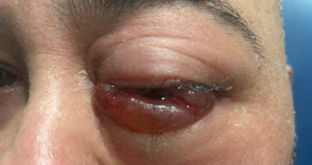 Carotid Cavernous Fistula Photograph. JETem 2026