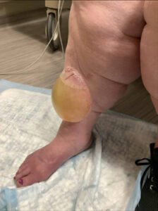 Edema Bulla. Photo 1. JETem 2026
