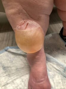 Edema Bulla. Photo 2. JETem 2026