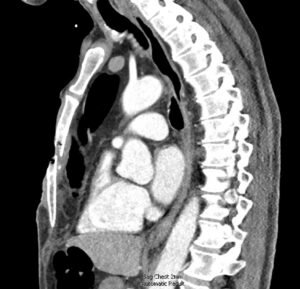 Open Chest Wound. CT. JETem 2026