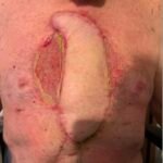 Open Chest Wound. Photo Post Surgery annotated. JETem 2026
