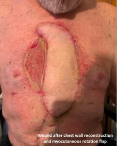 Open Chest Wound. Photo Post Surgery annotated. JETem 2026
