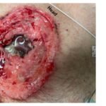 Open Chest Wound. Photo annotated. JETem 2026