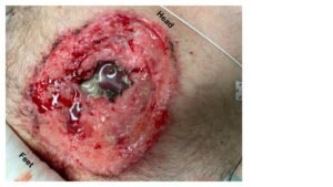 Open Chest Wound. Photo annotated. JETem 2026