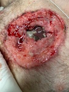 Open Chest Wound. Photo. JETem 2026