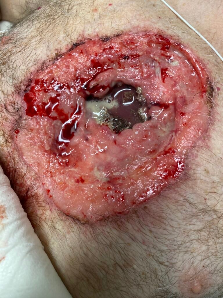 Open Chest Wound. Photo. JETem 2026