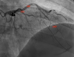 SCAD. Angiography Annotated. JETem 2026