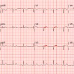 SCAD. ECG. Annotated. JETem 2026